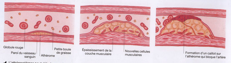 Plaque d athérome Wikimini lencyclopédie pour enfants