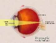 Hyperopia (1).gif